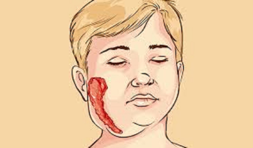 Autoridades de Salud de Magallanes alertan sobre incremento de las paperas