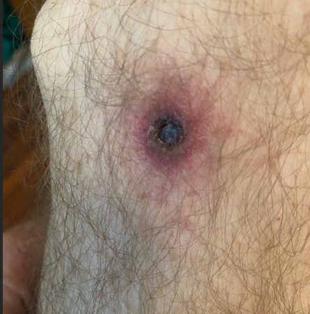 SEREMI de Salud Magallanes informa casos de «tifus de los matorrales» en la región y entrega medidas preventivas