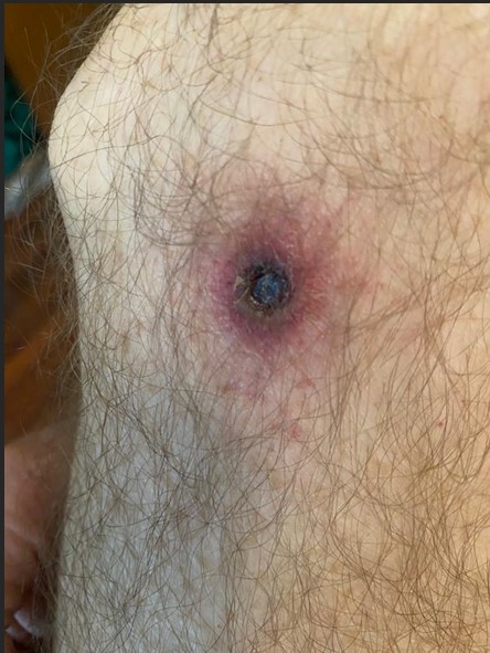 SEREMI de Salud Magallanes informa casos de «tifus de los matorrales» en la región y entrega medidas preventivas