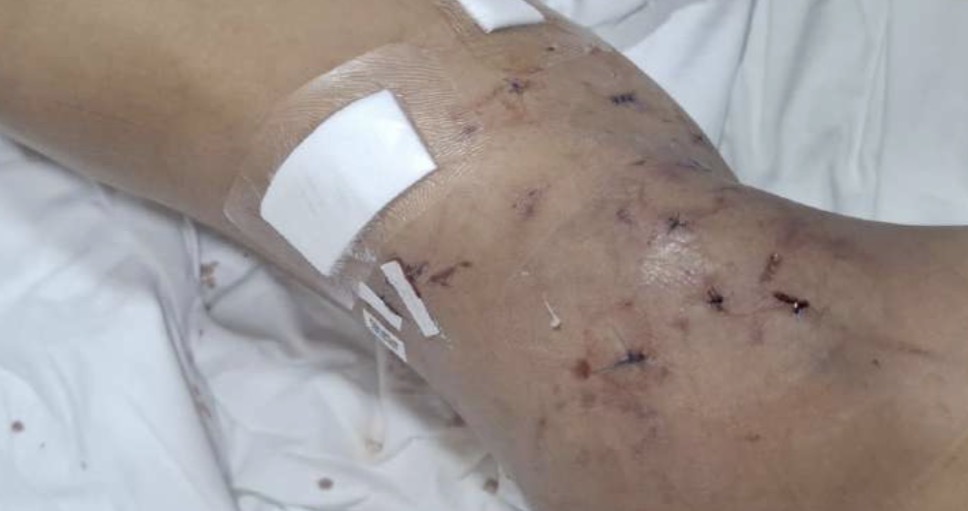 Jauría de seis perros ataca brutalmente a niño en sector periurbano de Punta Arenas